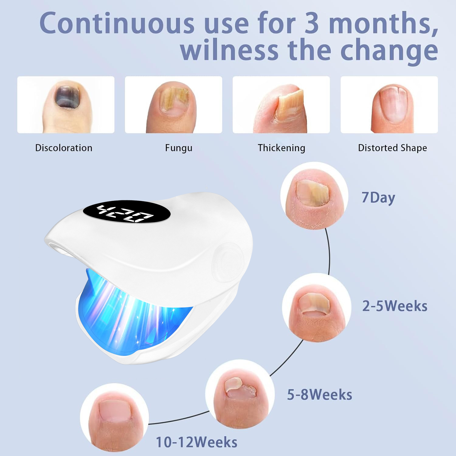 爪真菌レーザー装置 500NM 青色光 + 940NM 赤外 - Galvanic Skin Sensor のレビューと価格